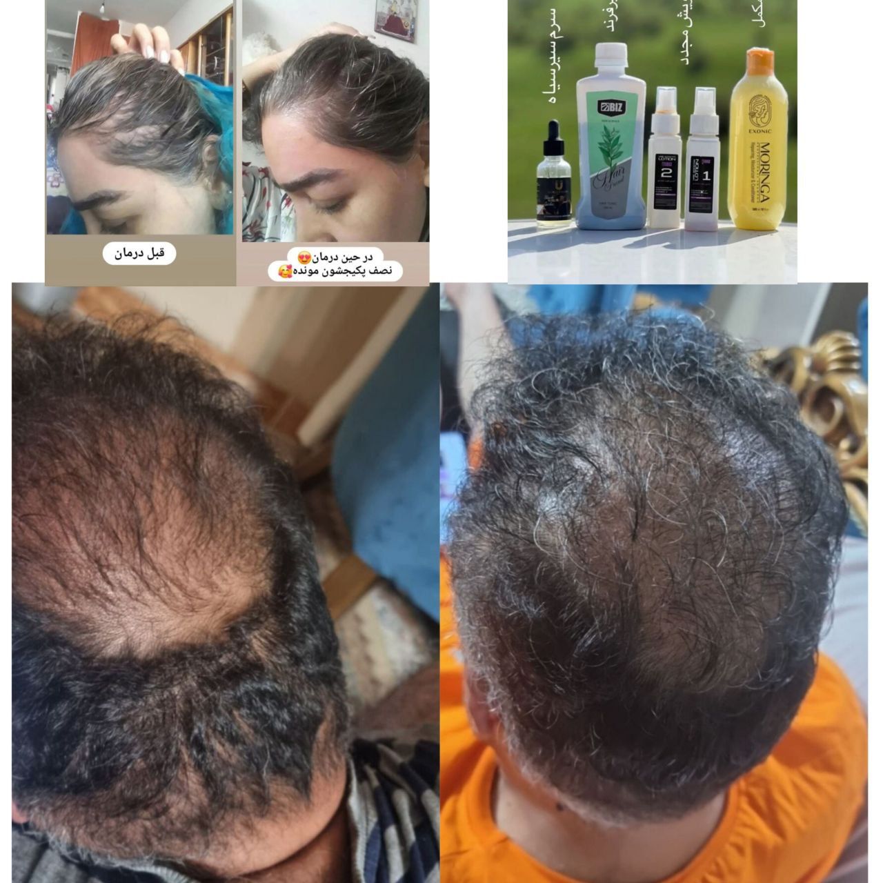رفع قطعی ریزش مو